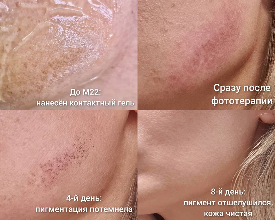 Чем выводить пигментные пятна